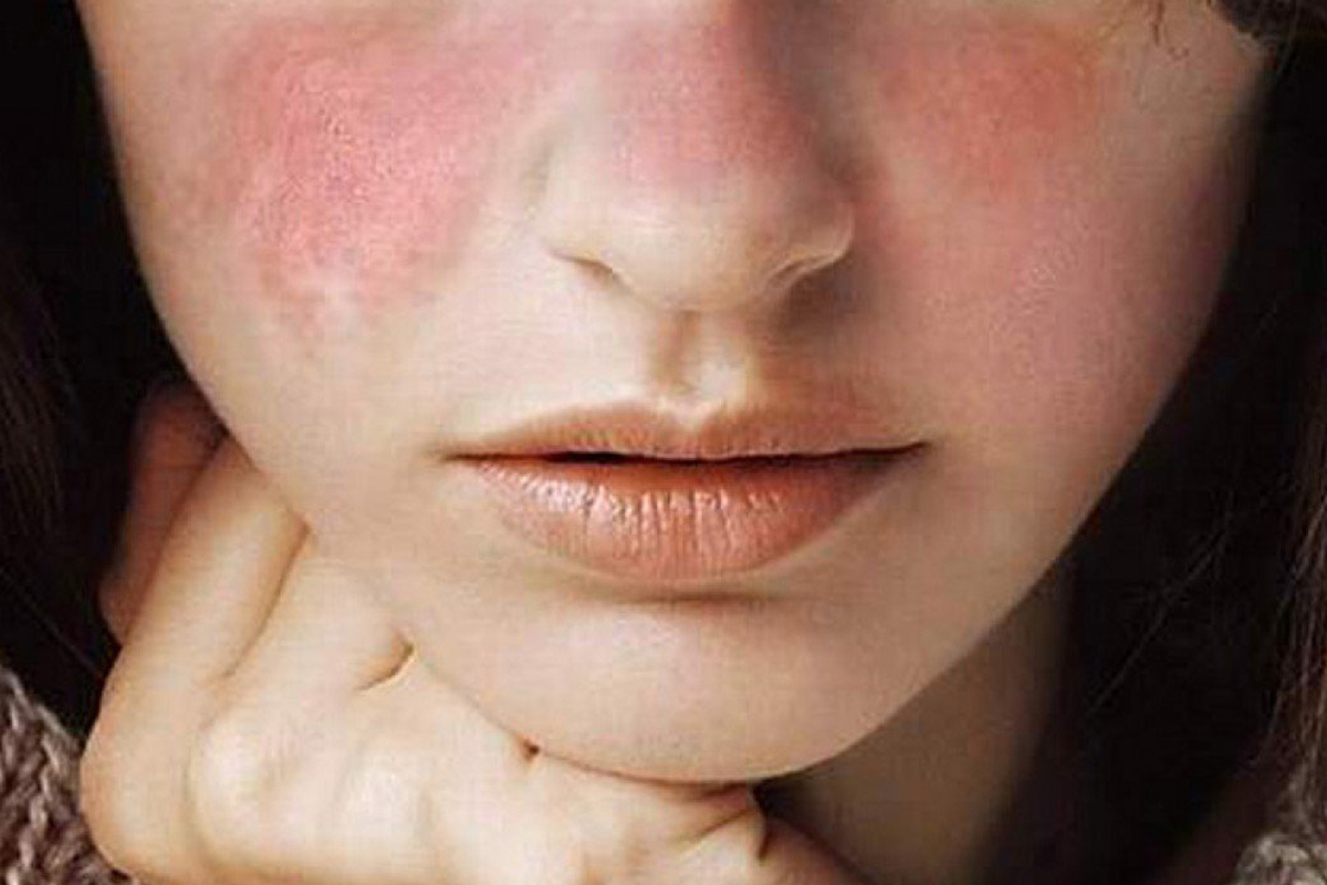 Sjogrens-Syndrome
